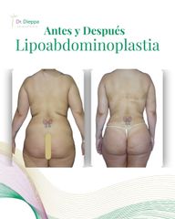 Lipoabdominoplastía - Cirugía Plástica Dieppa