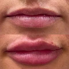 Aumento de labios - Clínica Dra. Karina Valdés