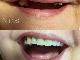 Implantes dentales - 835212