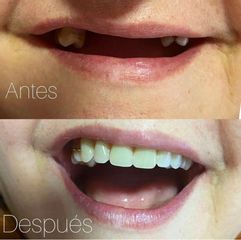 Implantes dentales - Clínica Dra. Karina Valdés