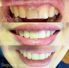 Blanqueamiento dental - Clínica Dra. Karina Valdés