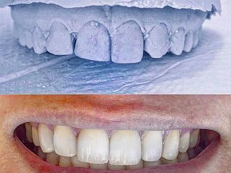 Limpieza dental - 835221