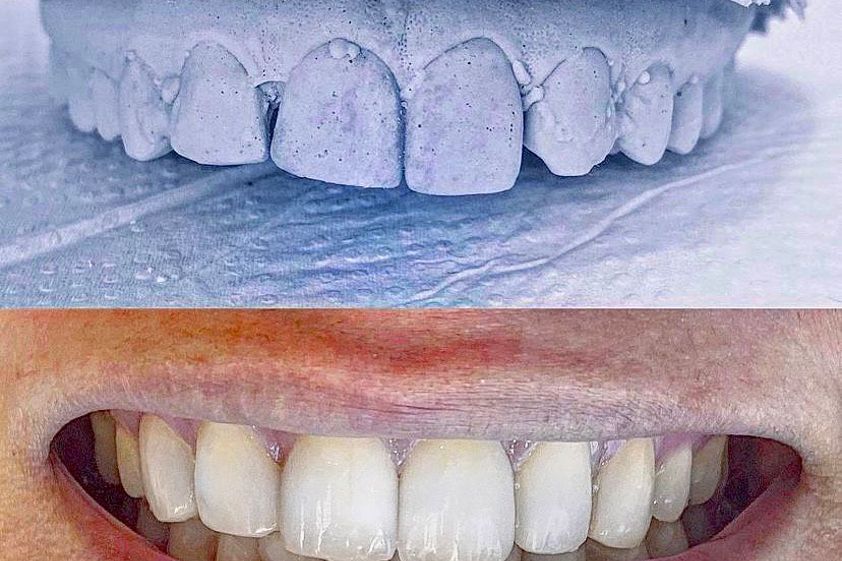 Limpieza dental antes y después - 835221