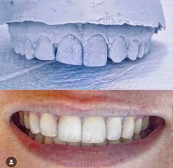 Limpieza dental - Clínica Dra. Karina Valdés