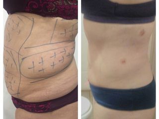 Láserlipolisis de Abdomen y lateral.