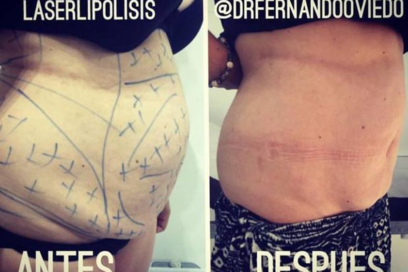 Lipoláser antes y después - 593178