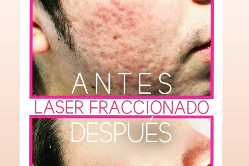 Tratamiento acné antes y después - 742474