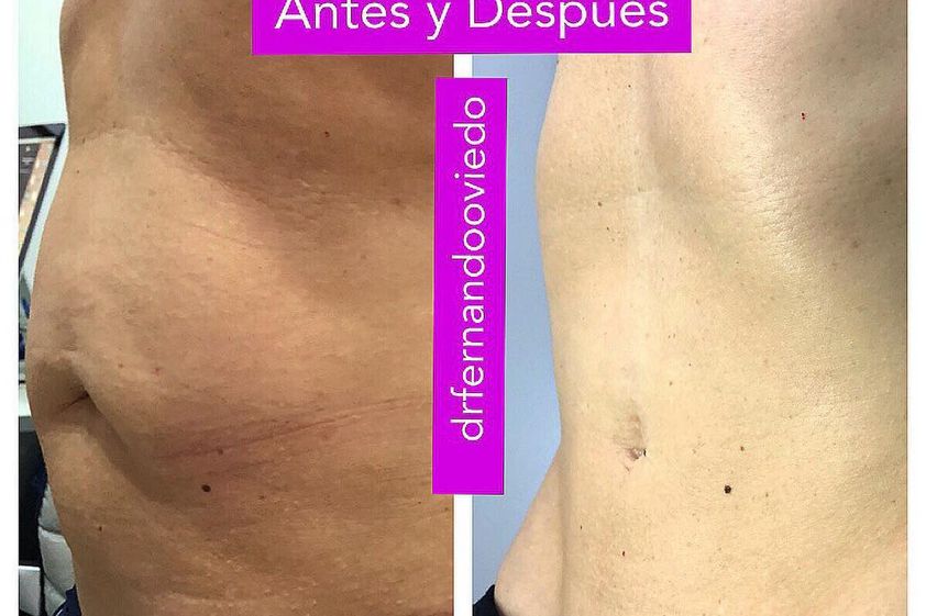 Lipoláser antes y después - 742480