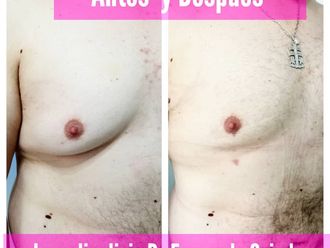 Lipoláser antes y después - 742483