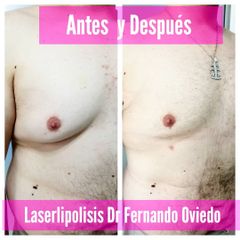 Lipoláser - Medical Esthetic Co