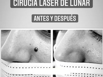 Lunares antes y después - 801069