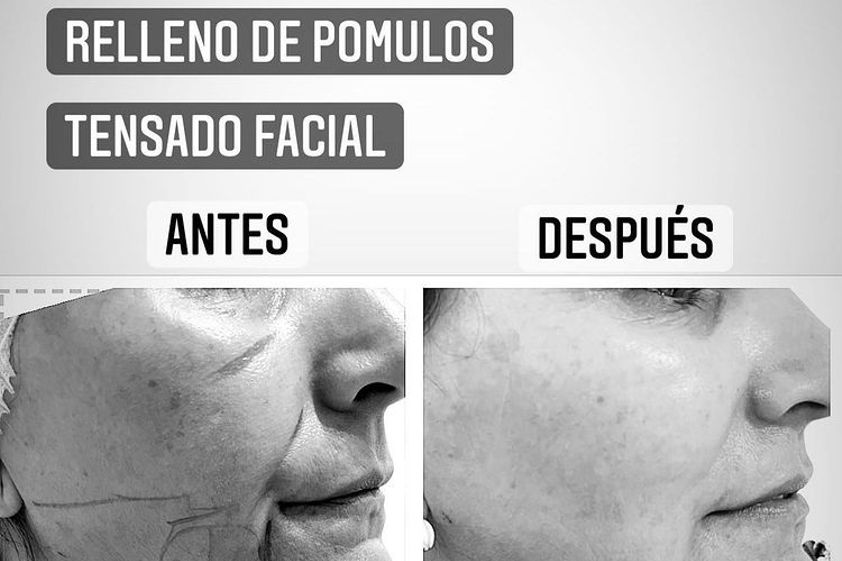 Lipoláser antes y después - 801070