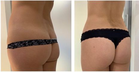 Aumento de glúteos - Medical Esthetic Co