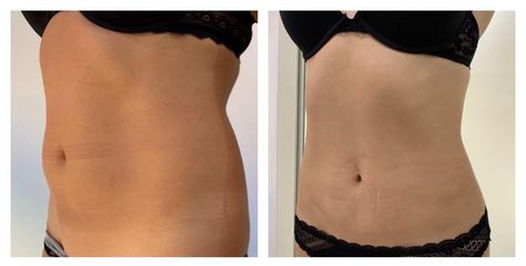 Liposucción - Medical Esthetic Co