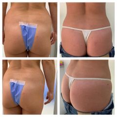 Aumento de glúteos - Medical Esthetic Co
