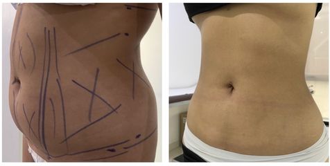 Liposucción - Medical Esthetic Co
