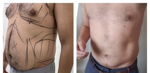 Liposuccón - Medical Esthetic Co