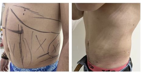 Liposuccón - Medical Esthetic Co