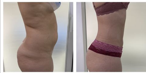Liposuccón - Medical Esthetic Co