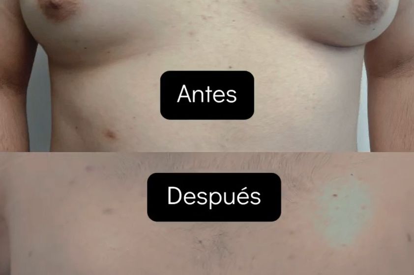 Ginecomastia antes y después - 853270