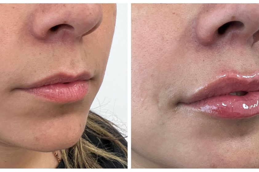 Aumento de labios antes y después - 864393
