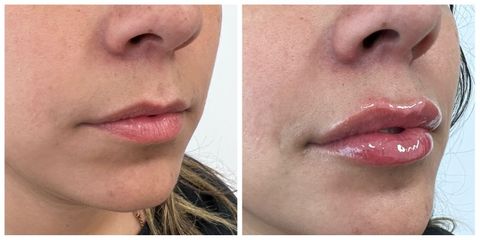 Aumento de labios - Clínica Oviedo