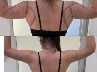 Liposucción antes y después - 867873