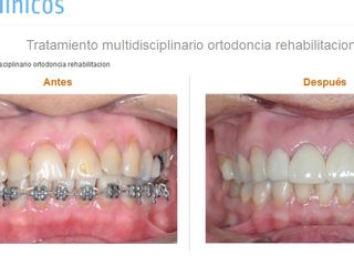 Tratamiento multidisciplinario ortodoncia rehabilitacion