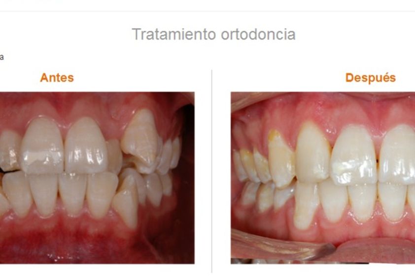 Ortodoncia invisible antes y después - 575412