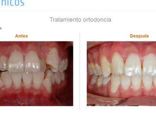 Tratamiento ortodoncia