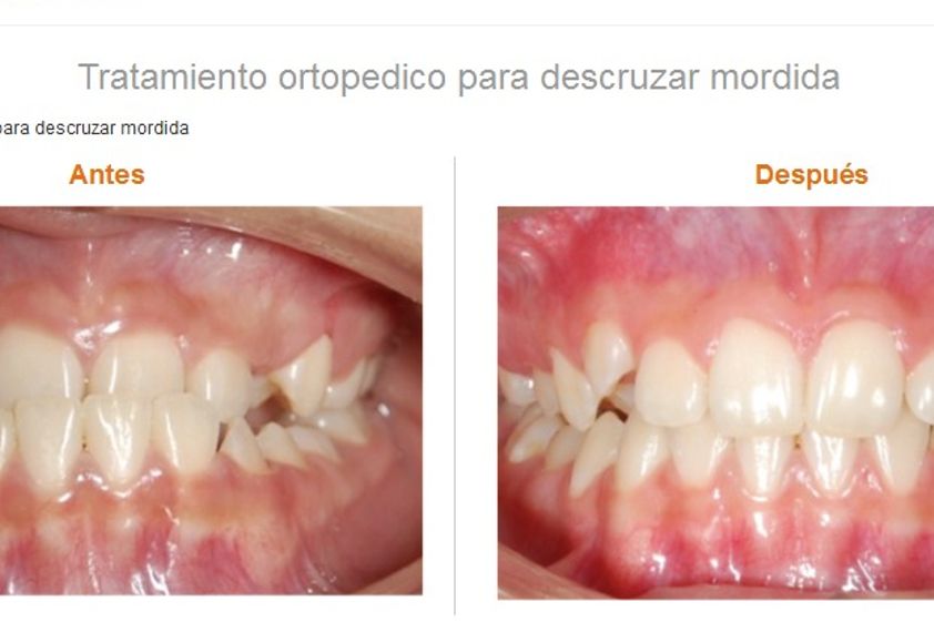 Brackets antes y después - 575413