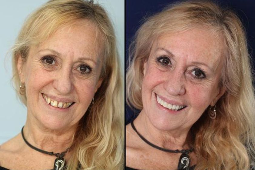 Implantes dentales antes y después - 548256