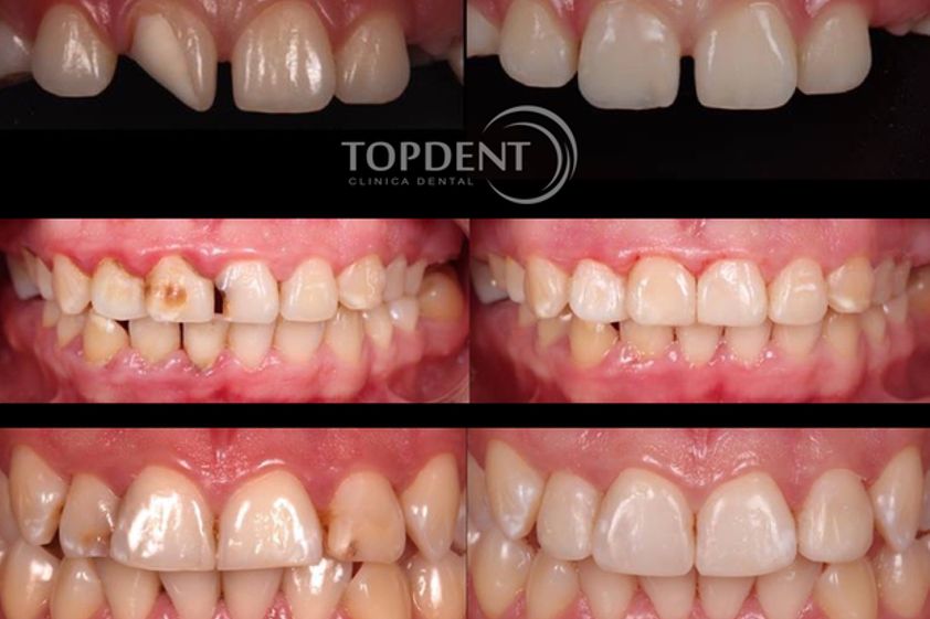 Endodoncia antes y después - 548398