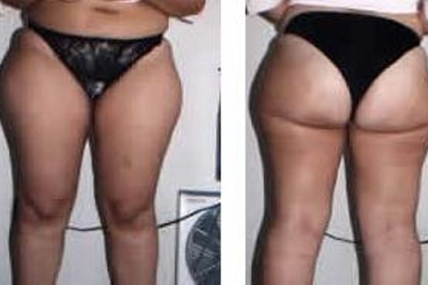 Tratamiento celulitis antes y después - 269031