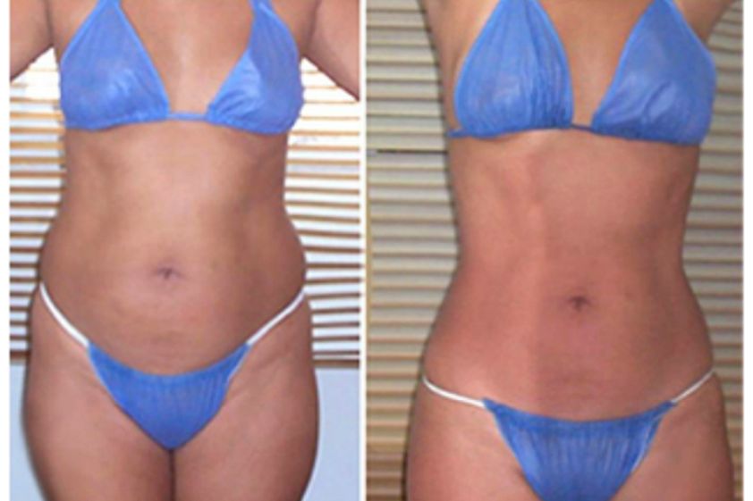 Mesoterapia antes y después - 497869