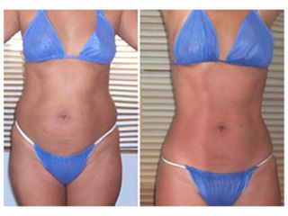 Mesoterapia
