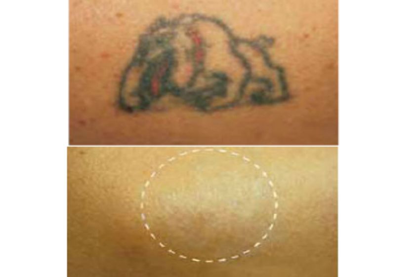 Borrar tatuajes antes y después - 497882