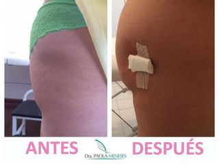 Antes y despues de Aumento de gluteos