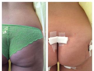Antes y despues de Aumento de gluteos