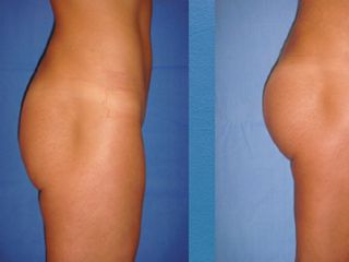 Antes y despues de hilos tensores en gluteos