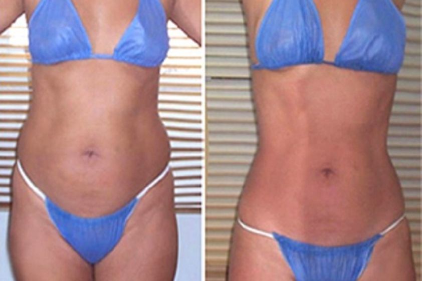 Mesoterapia antes y después - 597811
