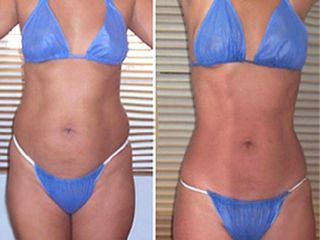 Antes y despues de mesoterapía corporal