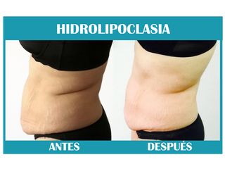 Tratamiento HIDROLIPOCLASIA