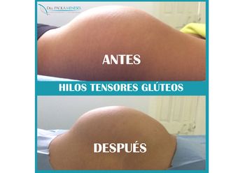 Hilos tensores - 609508