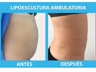 Lipoescultura  ambulatoria 