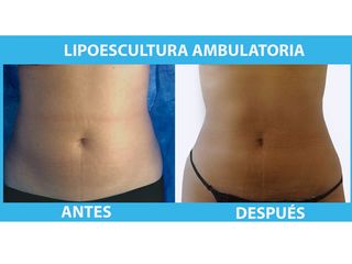 Lipoescultura  ambulatoria 