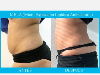 Liposucción - 638970