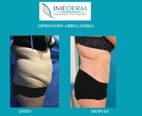 Liposucción - Dra Paola Meneses