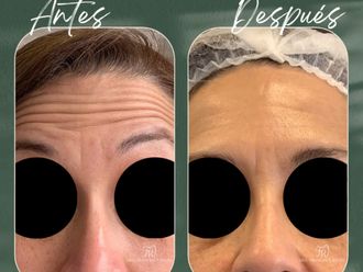 Bótox antes y después - 875492