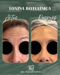 Tratamiento toxina botulínica - Dra. Francisca Reyes